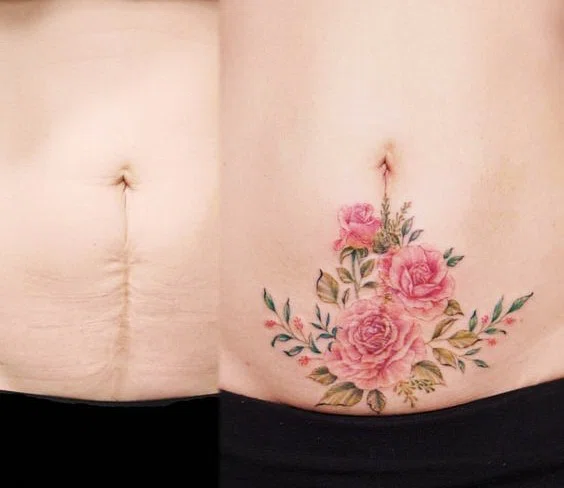 tatuaje para tapar la cicatriz que ha dejado la cesarea en el abdomen de una mujer. fotografía de antes y después de realizar el tatuaje